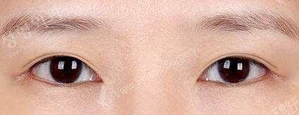 Double Eyelid Surgery (Incisional)+ Lateral Canthoplasty+Lower Canthoplasty (6 Months ) — After