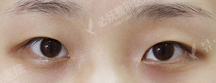 Fat Graft+Magic Epicanthoplasty+Lateral Canthoplasty (2 Months ) — Before