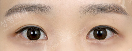 Fat Graft+Magic Epicanthoplasty+Lateral Canthoplasty (2 Months ) — After