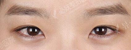 Incisional Ptosis Correction+Magic Epicanthoplasty (7 Months ) — Before