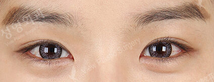 Incisional Ptosis Correction+Magic Epicanthoplasty (7 Months ) — After