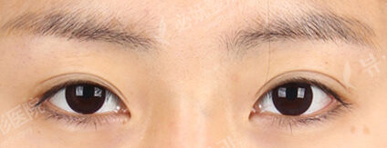 Incisional Ptosis Correction (Revisional Eye Surgery) (11 Months ) — Before