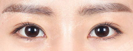 Incisional Ptosis Correction (Revisional Eye Surgery) (11 Months ) — After