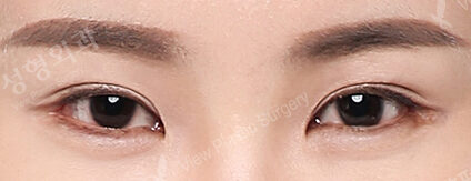 Combination Ptosis Correction Surgery (Revisional Surgery)+ Lateral Canthoplasty+Lower Canthoplasty (6 Months) — After