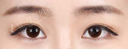 Magic Epicanthoplasty (Revisional Eye Surgery)+ Lateral Canthoplasty+Lower Canthoplasty (6 Months ) — After