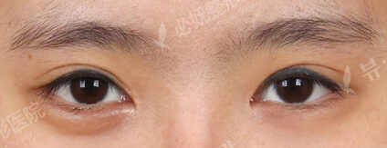 Incisional Ptosis Correction+Lower Canthoplasty (4 Months ) — Before