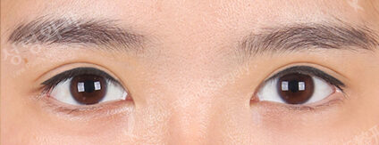 Incisional Ptosis Correction+Lower Canthoplasty (4 Months ) — After