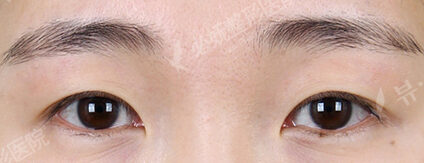 Fat Graft+Magic Epicanthoplasty+Lateral Canthoplasty (5 Months ) — Before