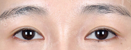 Fat Graft+Magic Epicanthoplasty+Lateral Canthoplasty (5 Months ) — After