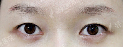 Fat Graft+Lateral Canthoplasty (1 Months ) — Before