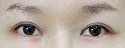Fat Graft+Lateral Canthoplasty (1 Months ) — After