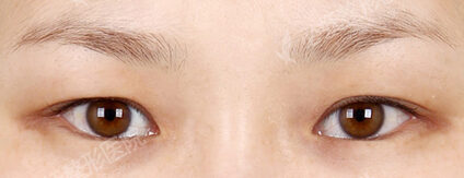 Fat Graft+Lateral Canthoplasty+Lower Canthoplasty (23 Months ) — Before