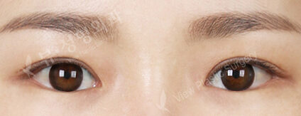 Fat Graft+Lateral Canthoplasty+Lower Canthoplasty (23 Months ) — After