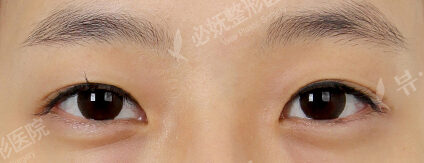 Transconjuntival fat removal (1 Months ) — Before