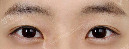 Transconjuntival fat removal (1 Months ) — After