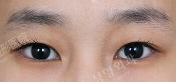 Fat Graft+Magic Epicanthoplasty+Lateral Canthoplasty (3 Months ) — Before