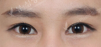 Fat Graft+Magic Epicanthoplasty+Lateral Canthoplasty (3 Months ) — After