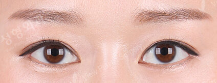 Fat Graft (Revisional Eye Surgery)+ Lateral Canthoplasty+Lower Canthoplasty (3 Months ) — After