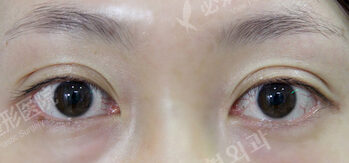 Transconjuntival fat removal (2 Week ) — Before