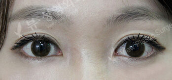 Transconjuntival fat removal (2 Week ) — After