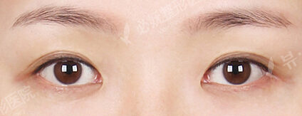 Combination Ptosis Correction Surgery (5 Months) — Before