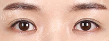 Combination Ptosis Correction Surgery (5 Months) — After