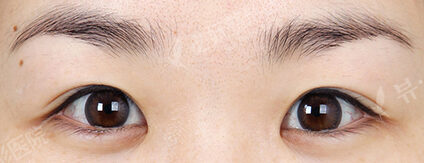 Magic Epicanthoplasty (1 Months ) — Before