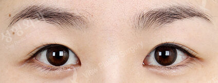 Magic Epicanthoplasty (1 Months ) — After