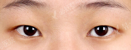 Combination Ptosis Correction Surgery (2 Months ) — Before