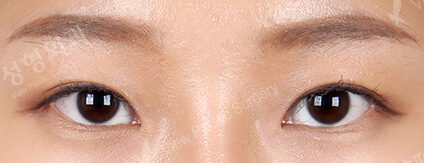 Combination Ptosis Correction Surgery (2 Months ) — After