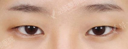 Combination Ptosis Correction Surgery+Magic Epicanthoplasty (1 Months ) — Before