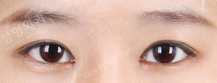 Combination Ptosis Correction Surgery+Magic Epicanthoplasty (1 Months ) — After