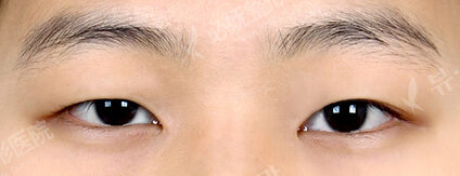 Combination Ptosis Correction Surgery (11 Months ) — Before
