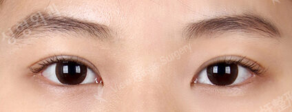Combination Ptosis Correction Surgery (11 Months ) — After