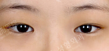 Combination Ptosis Correction Surgery+Magic Epicanthoplasty(1 Months ) — Before
