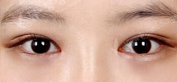Combination Ptosis Correction Surgery+Magic Epicanthoplasty(1 Months ) — After