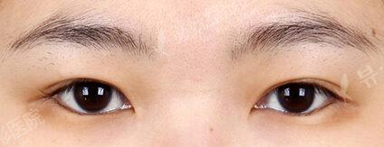 Lateral Canthoplasty (1 Months ) — Before
