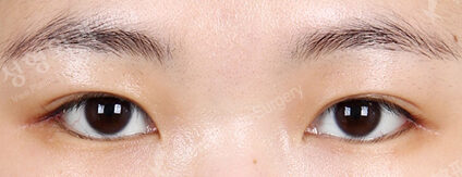 Lateral Canthoplasty (1 Months ) — After