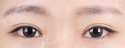 Combination Ptosis Correction Surgery+Magic Epicanthoplasty+Lower Canthoplasty+Transconjuntival fat removal (4 Months) — After