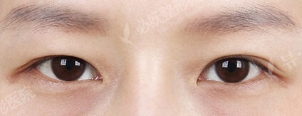 Transconjuntival fat removal — Before