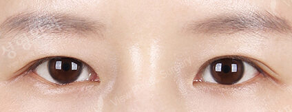 Transconjuntival fat removal — After
