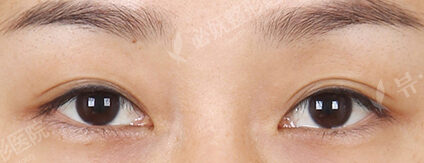 Transconjuntival fat removal — Before