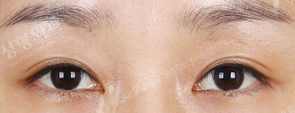 Transconjuntival fat removal — After