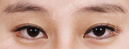 Incisional Ptosis Correction (5 Months ) — Before