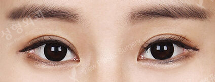 Incisional Ptosis Correction (5 Months ) — After