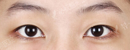 Combination Ptosis Correction Surgery+Transconjuntival fat removal (4 Months) — Before