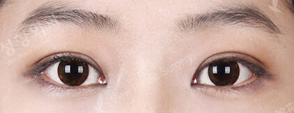 Combination Ptosis Correction Surgery+Transconjuntival fat removal (4 Months) — After