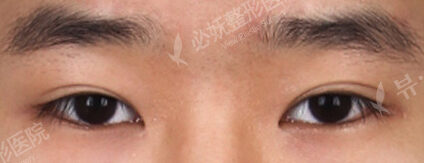 Ptosis Correction (Revisional Surgery)+ Lateral Canthoplasty+Lower Canthoplasty (2 Months) — Before