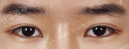Ptosis Correction (Revisional Surgery)+ Lateral Canthoplasty+Lower Canthoplasty (2 Months) — After