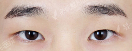 Fat Graft+Magic Epicanthoplasty+Lateral Canthoplasty (1 Months ) — Before